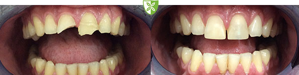Before and after white filings image from St Johns Road Dental Practice