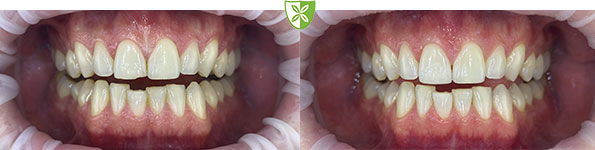 Composite teeth bonding by Dr Saigal in Leicester