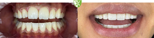 Composite bonding from St Johns Rd Dental Practice in Leicester