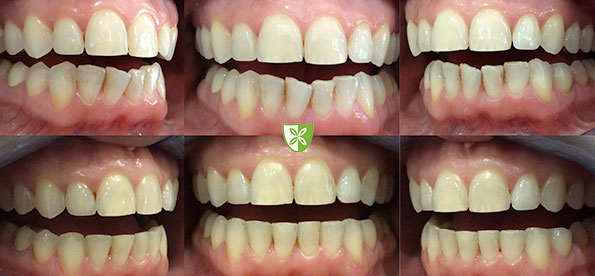 Cfast clear aligners treatment example from St Johns Road Dental Practice