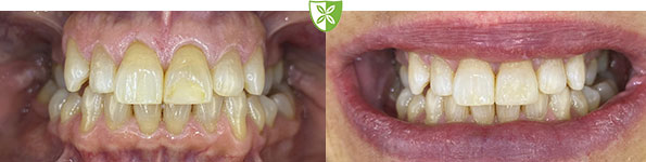 Composite bonding by St Johns Rd Dental Practice in Leicester