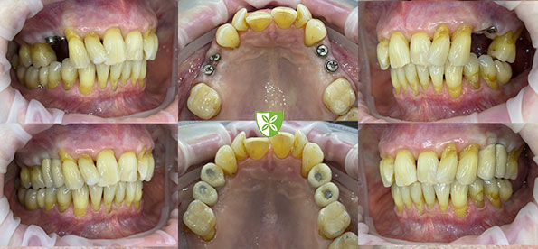 Dental Implanats treatment example photos in Leicester