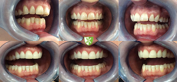 Invisalign Clear Aligners before and after treastment images from St Johns Road Dental