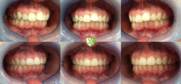 Invisalign Clear Aligners treatment by St Johns Rd Dental in Leicester