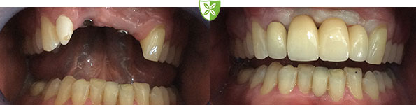 Dental Implants before and after treatment by the Leicester Dentist