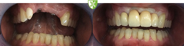 28 Dental Implants before and after treatment at St Johns Road Dental in Leicester.jpg