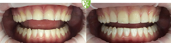 Dental Veneers before and after treatment images from The Leicester Dentist