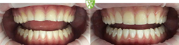 Before and after dental veneers treatment in Leicester