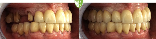 Dental bridge treatment in Leicester before and after treatment images