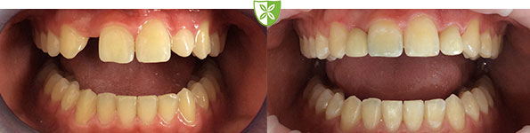 Dental Crown and Bridge Treatment Image