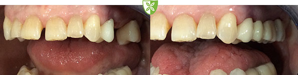 Dental bridge treatment image from Leicester Dentist
