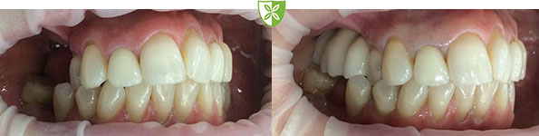 Replace missing teeth with dental implants at Leicester Dentist - see before and after treatment image
