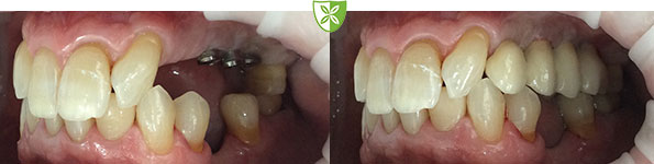 Before and after dental implants images of side teeth by The Leicester Dentist