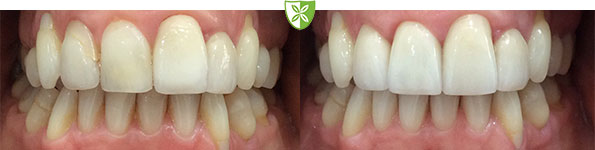 White fillings before and after images at Leicester Dentist
