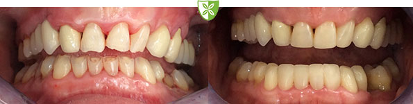 Composite bonding images inLeicester by St Johns Rod Dental