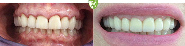 Before and after dental crowns treatment