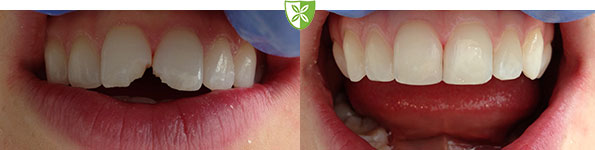 Composite fillings by Leicester Dentist St Johns Road Dental