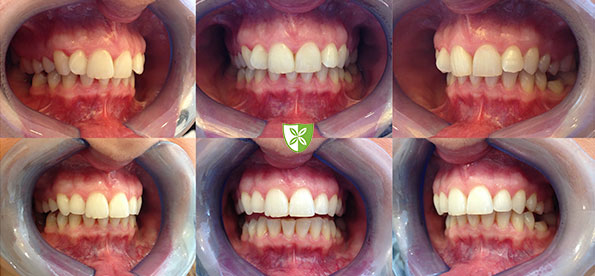 56 Invisalign-before-and-after-treatment-St-Johns-Rd-Dental