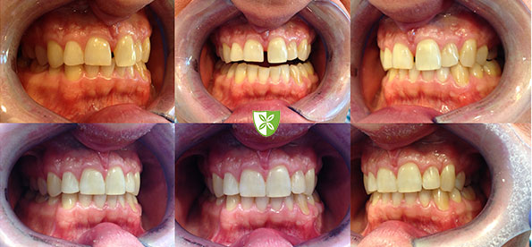 57 Invisalign before and after-treatment-St-Johns-Rd-Dental