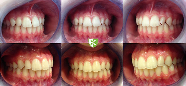 60 Invisalign before and after treatment-St-Johns-Rd-Dental.jpg