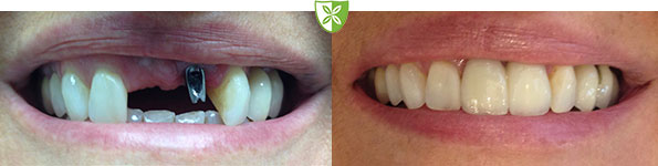 Dental Implants treatment example image from Leicester Dentist