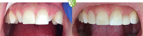 Teeth composite bonding case study 74 from St Johns Road Dental Practice