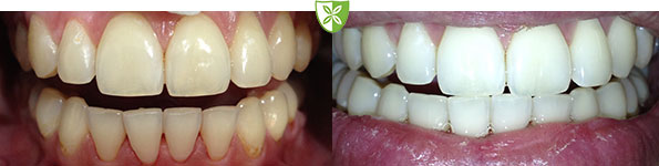 before-and-after-teeth-whitening-treatment-in-Leicester.jpg