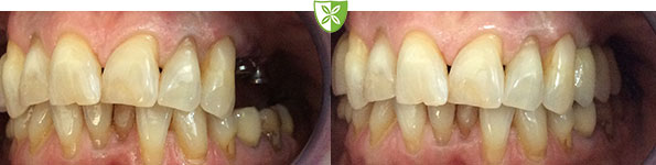 Dental Implants images from St Johns Road Dental in Leicester
