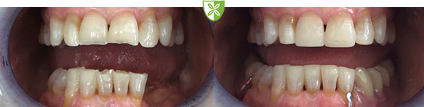 Dentures before and after treatment images from The Leicester Dentist