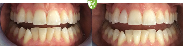 Composite bonding images by St Johns Rd Dental in Leciester