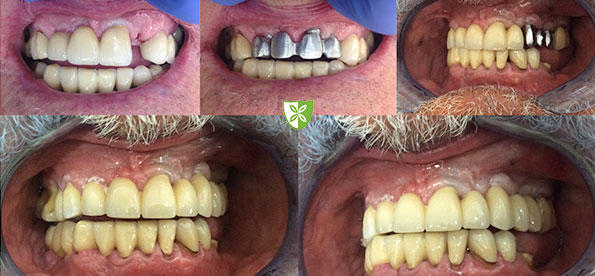 Dental implants msile makeover by st johns road dental in Leicester