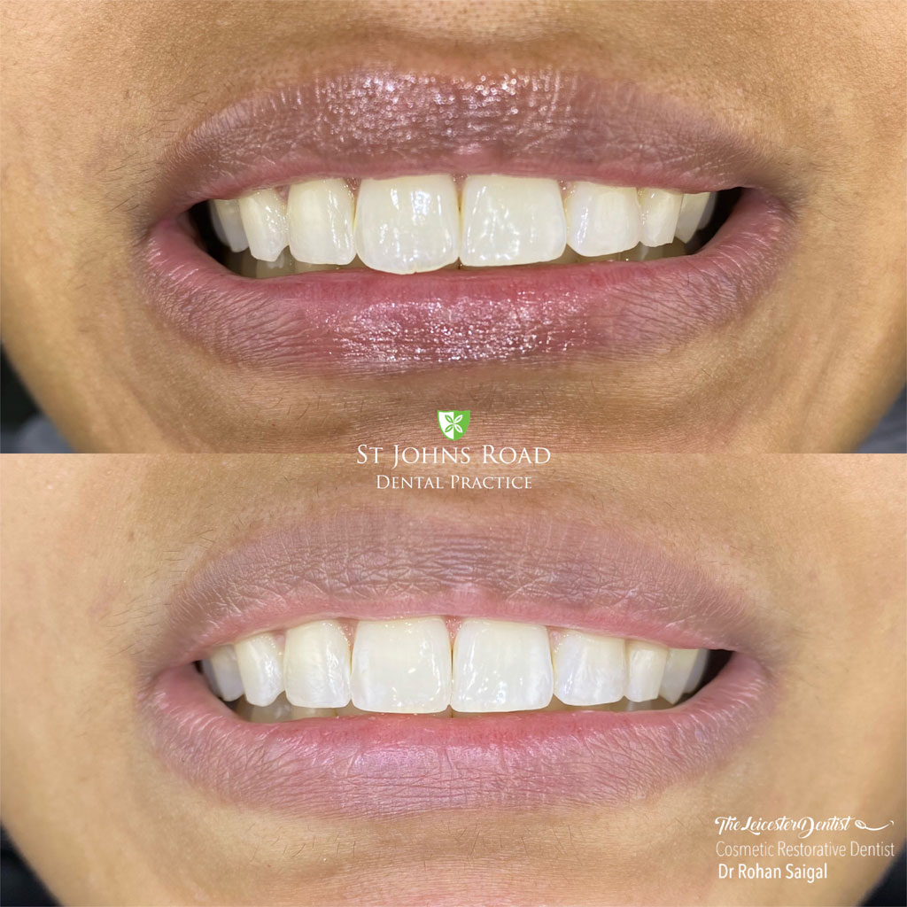 Before and After Teeth Straightening in Leicester case study 5