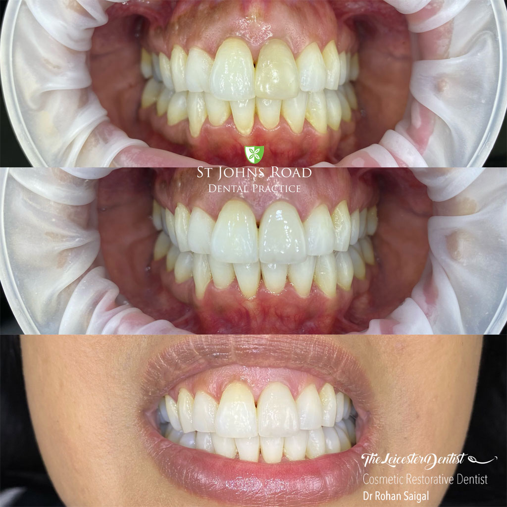 Before and After Teeth Straightening in Leicester case study 5