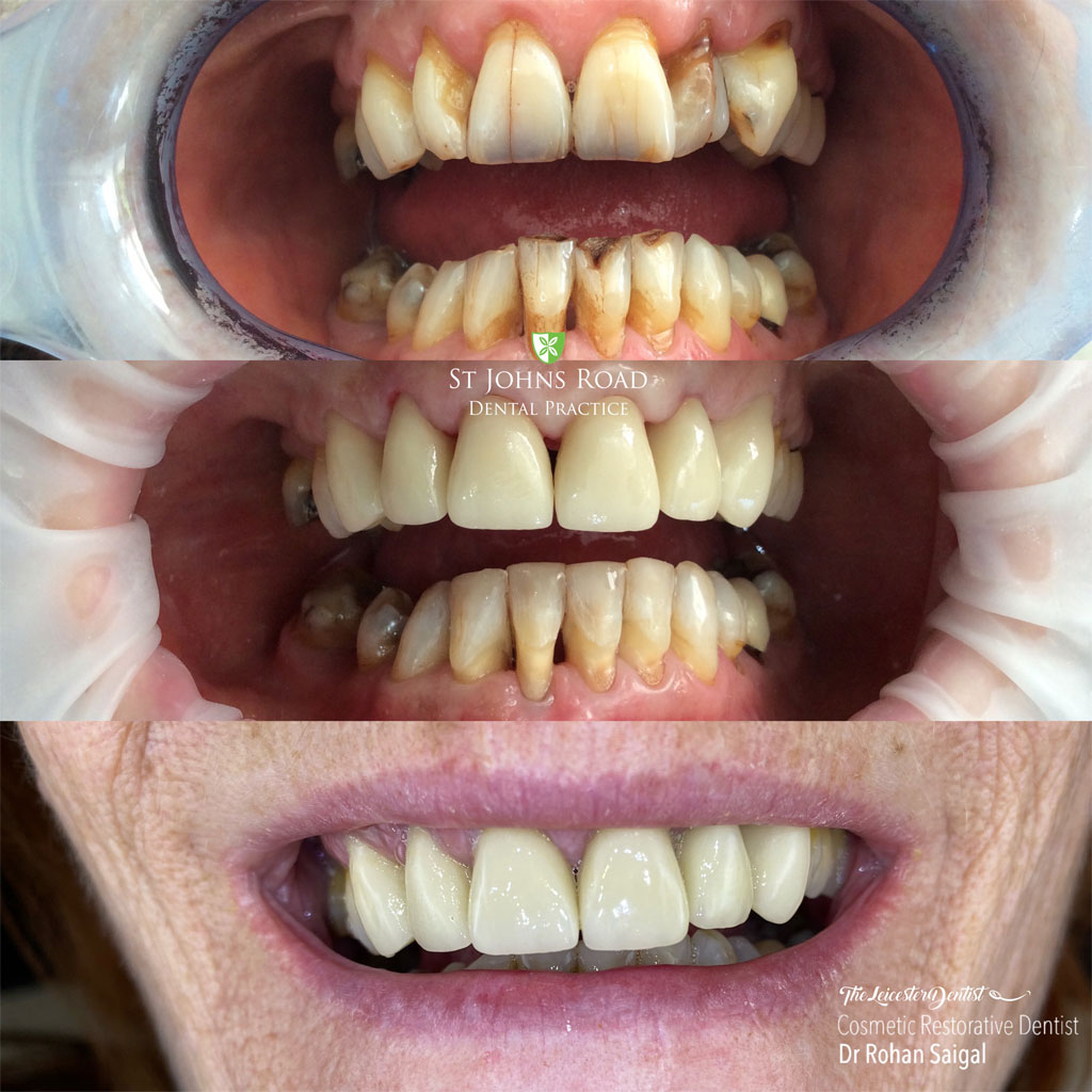 Before and After Invisalign Clear Braces in Leicester