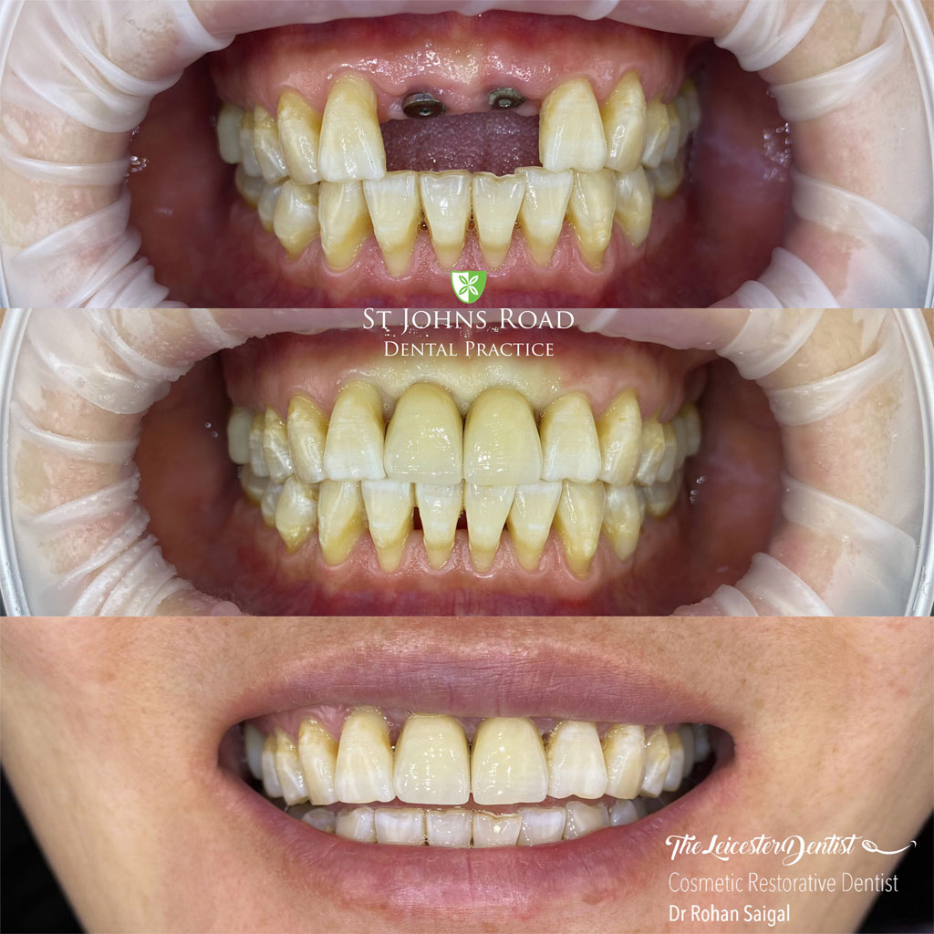 Before and After Invisalign Clear Braces in Leicester